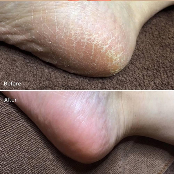 Liberta Baby Foot Exfoliation Foot Peal for Men 60 Minutes Treatment